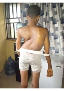 Read more about the article Complex spinal deformity correction